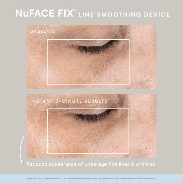 NuFACE FIX® Starter Kit | NuFACE